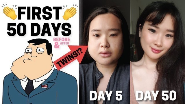 'BEFORE & AFTER KOREAN PLASTIC SURGERY RECOVERY | DOCFINDERKOREA ID HOSPITAL | First 50 Days PART 2'