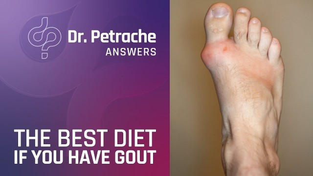 'BEST DIET IN GOUT'