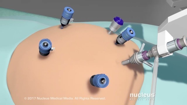 'Weight Loss Surgery: Robotic Bariatric Procedure'