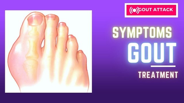 'Gout: symptoms, intervention, treatment of acute and chronic Gout. (Food avoid in Gout)'