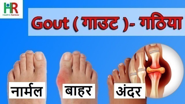 'gout cause | how to prevent gout | foods that cause gout | gout diagnosis | Gout treatment | diet |'