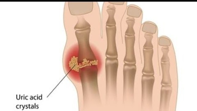 'What Is Gout ? - What To Avoid‎ & What To Eat.'