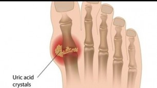 'What Is Gout ? - What To Avoid‎ & What To Eat.'