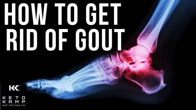 'Can You Get Rid of Gout? | Foods That Trigger Gout | Low Purine Foods to Eat | THE BEST GOUT DIET'