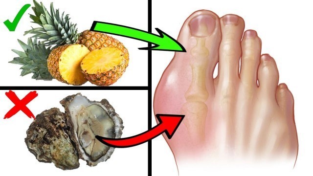 'What Are The Best and Worst Foods to Eat with Gout'